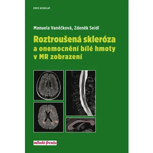 Roztroušená skleróza a onemocnění bílé hmoty v MR zobrazení - Zdeněk Seidl, Manuela Vaněčková